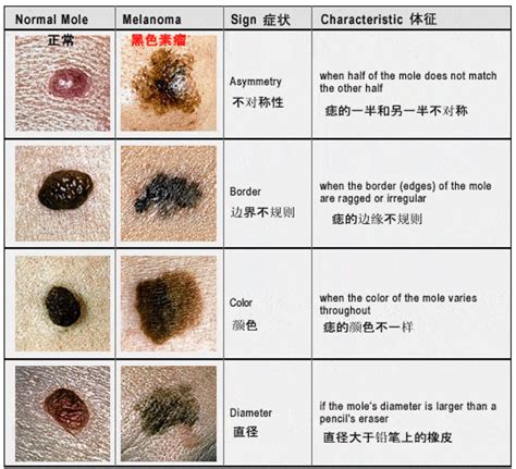 身体痣|痣也可能会癌变！长在 3 个地方要注意